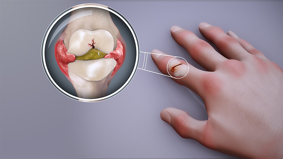 File:Rheumatoid arthritis - Swollen finger joint.jpg