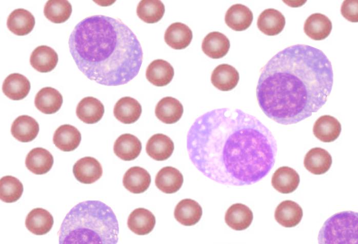 File:Plasma cell leukemia.jpg
